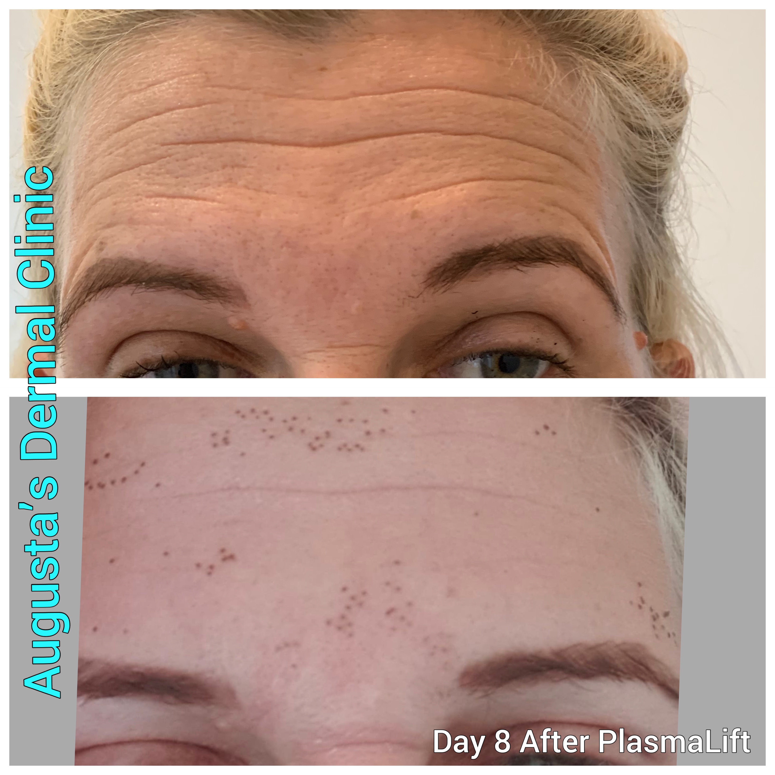 Shanna has had PlasmaLift Before & After 8 days
