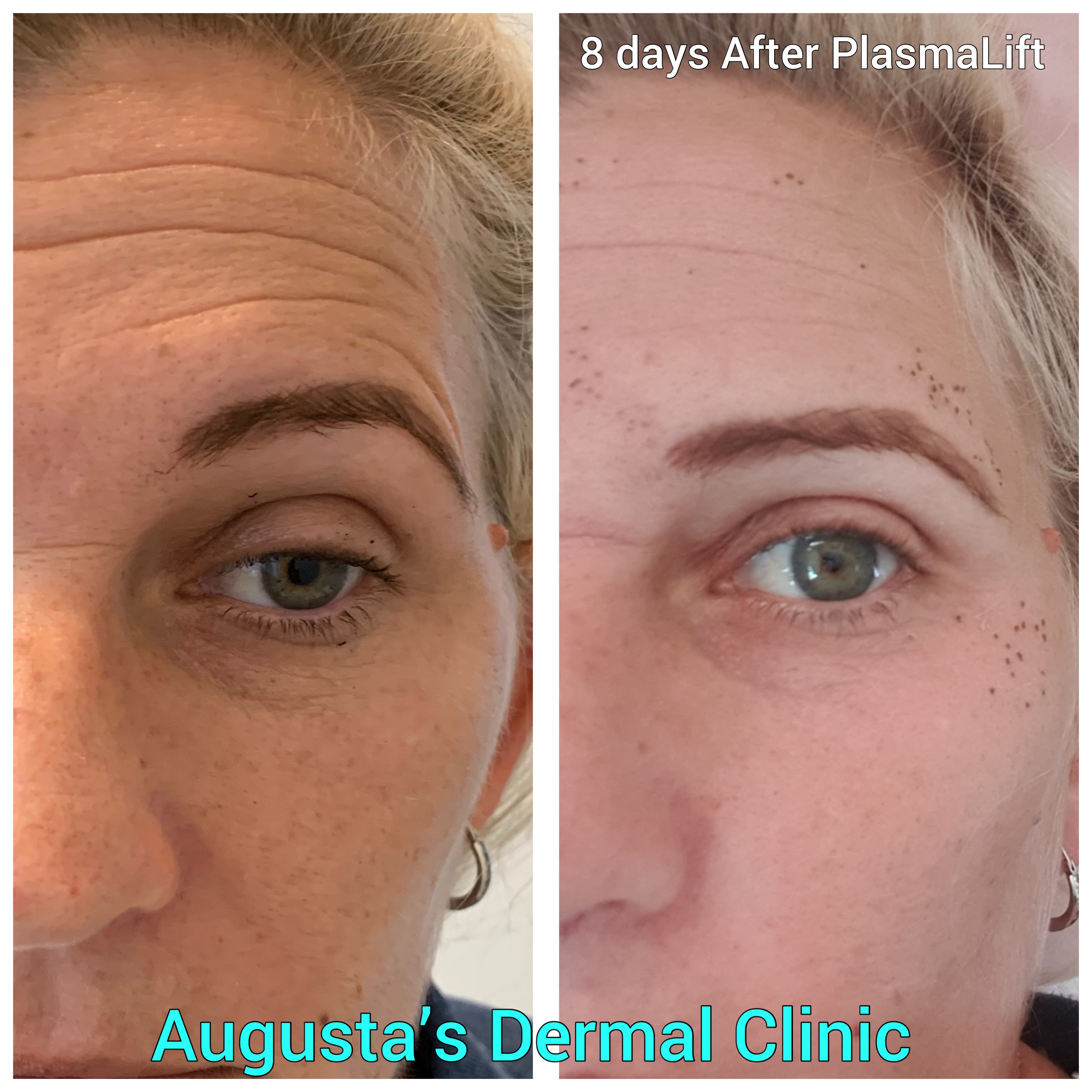 Shanna has had PlasmaLift treatment on her deep lines on her forehead and lines around her eyes . This is day 8 after her treatment and the rest of the carbon crusts spots will be off in the next day. The skin improves upto 3 months after having PlasmaLift . A second treatment can be performed after this time.