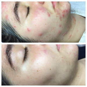 Problematic acne treated with Mezotix